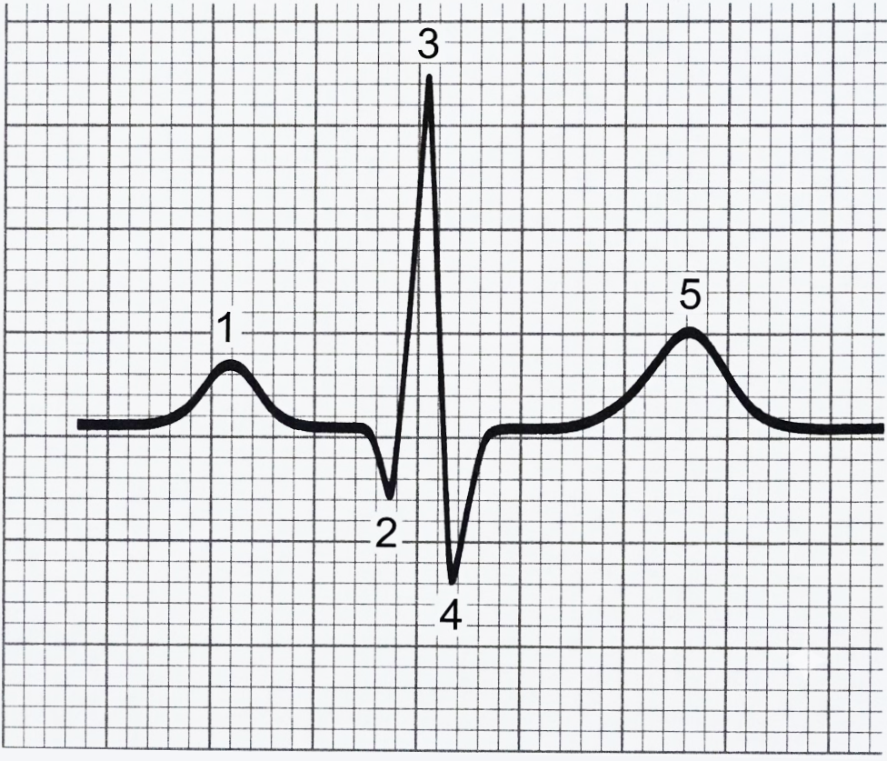 Traseu ECG pe hârtie milimetrică cu undele notate 1–5